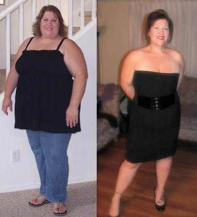Lap Band Weight Loss Journey Stories
